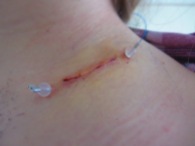 -Late entry but March 2013, post biopsy still stitched.